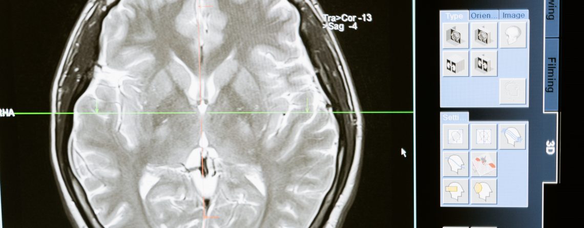 Why a Brain Injury Attorney is Necessary for a TBI