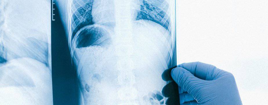 Spleen Injuries After Bicycle Accidents