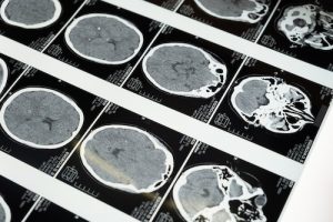 Follow-up Care Can Improve Outcomes for TBI Sufferers
