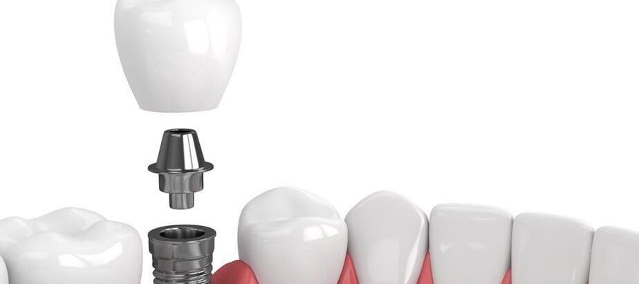 Dental Implants and Dental Malpractice: Most Common Breaches of Care